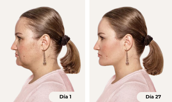 Levantamiento de papada: Nunca más me avergüenzo de mi papada